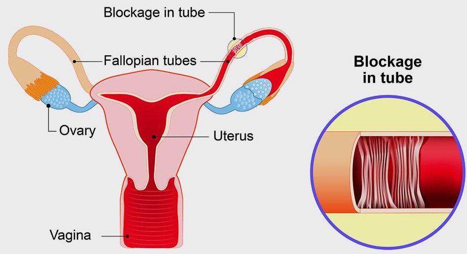 The treatment methods for blocked fallopian tubes