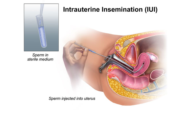 I.U.I. - INTRAUTERINE INSEMINATION